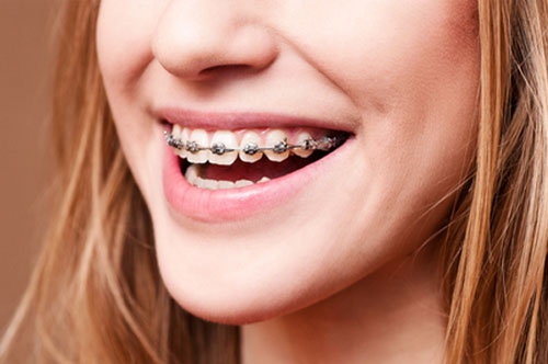 Orthodontic Assisted Care: Beyond Basic Braces